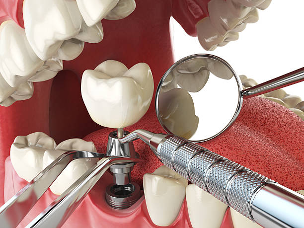 Best Emergency Dental Care for Broken or Chipped Teeth in Lillian, AL